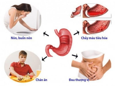 5 nguyên tắc ăn uống cho người bị viêm dạ dày, nên "tuân thủ" để làm dịu cơn đau hiệu quả